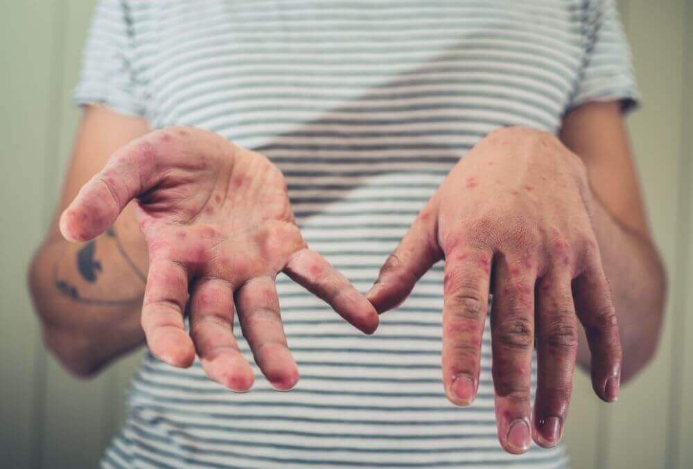 Person showing her hand with rat bite fever rashes